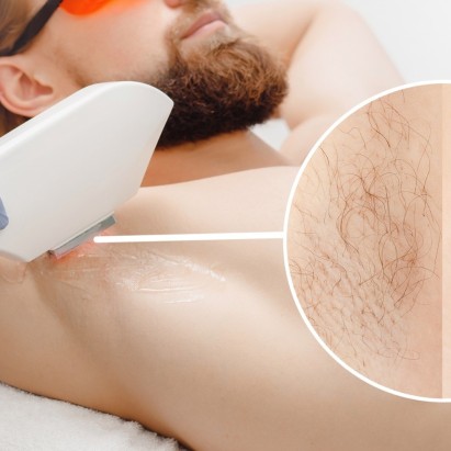 Laser Aisselles — 30 min