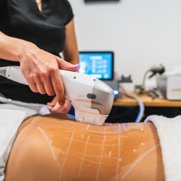 HIFU des bras — 45 min